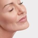 Producto - Exosomas + HIFU Rostro, cuello y Escote