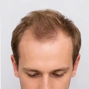 Cabello castaño claro con cabello muy fino y débil en la coronilla.