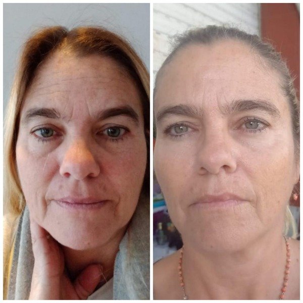 Producto - HIFU + EXOSOMAS NACIONALES (rostro+sub.menton)