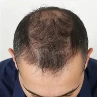 Cabello castaño oscuro con pelo fino y raleado antes de aplicar fibras capilares Trick Hair Fiber.