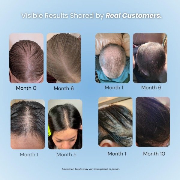 Producto - growplex Hair Loss Prevention Kit - 4