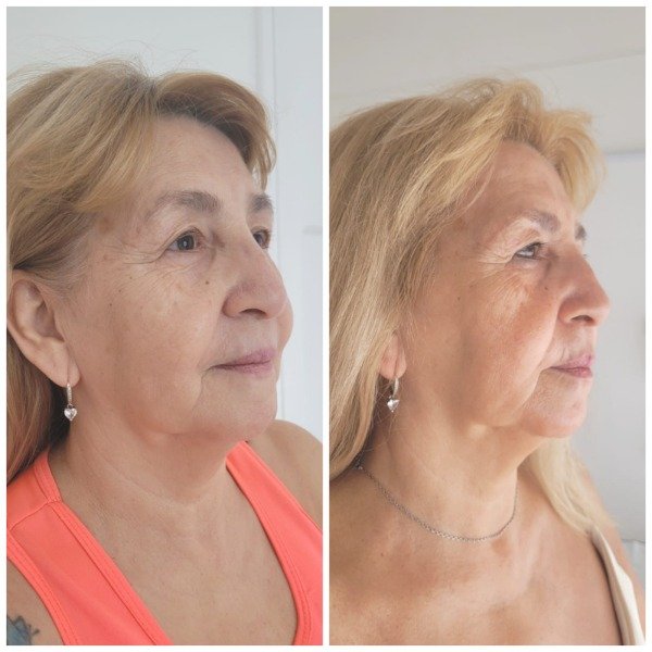 Producto - HIFU + HIGIENE BASICA (rostro+cuello+escote) - 2