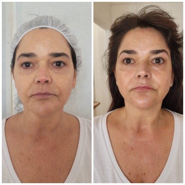 Producto - HIFU + EXOSOMAS PREMIUM (rostro+cuello+escote)