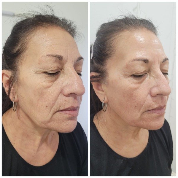 Producto - HIFU + SHOCK de NUTRICION PREMIUM (Rostro + sub-menton) - 2