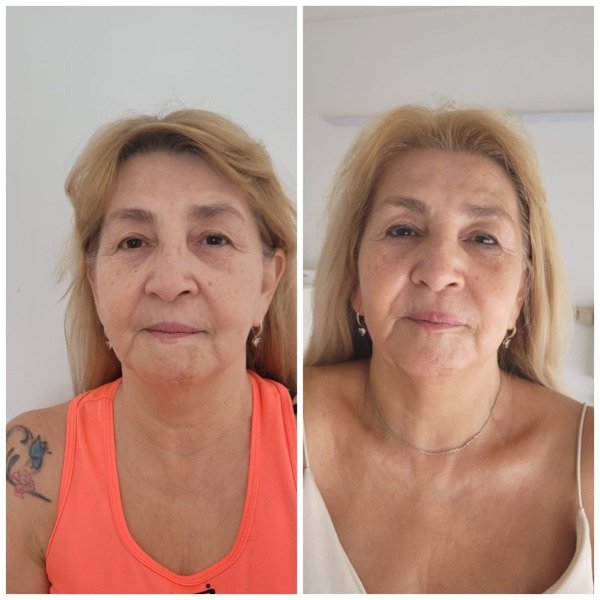 Producto - HIFU + HIGIENE BASICA (rostro+cuello+escote) - 0