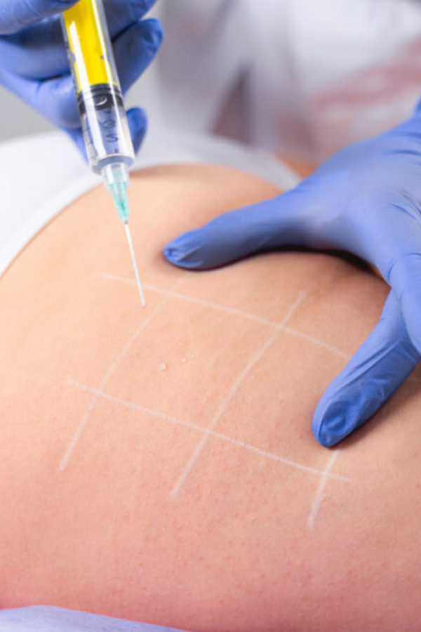 Producto - Mesoterapia Corporal Adiposidad / Celulitis / Estrias / Flaccidez