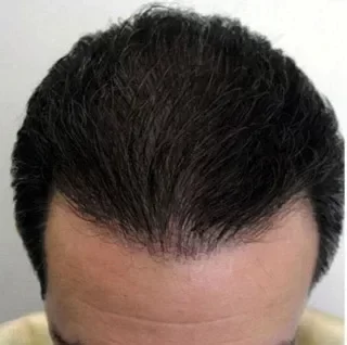 Cobertura total de entradas y coronilla en cabello negro tras aplicar fibras capilares Trick Hair Fiber, resultado con mayor volumen y densidad.
