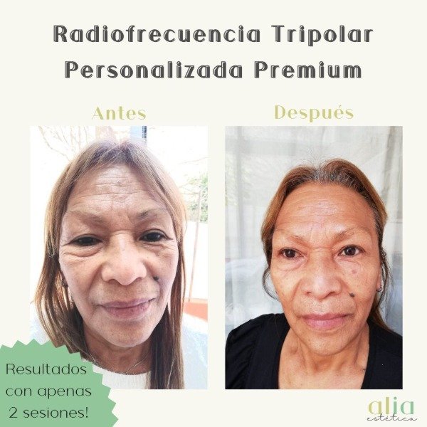 Producto - Radiofrecuencia + Exosomas  Premiums + Higiene profunda - 1