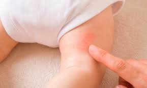 Producto - 2x1 PASTA LASSAR - paspaduras, picaduras, dermatitis- - 2