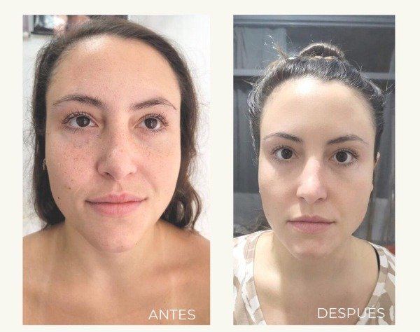 Producto - HIFU + EXOSOMAS PREMIUM (rostro+sub.menton) - 0