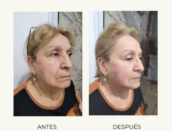 Producto - HIFU + HIGIENE BASICA (rostro+sub-menton) - 1