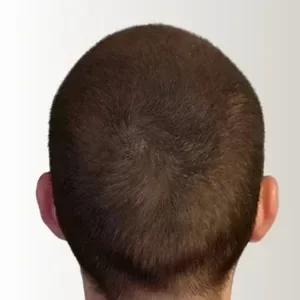 Efecto de densidad capilar en coronilla castaño medio, zonas de calvicie cubiertas con Trick Hair Fiber.