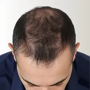 Cabello castaño oscuro con pelo fino y raleado antes de aplicar fibras capilares Trick Hair Fiber.