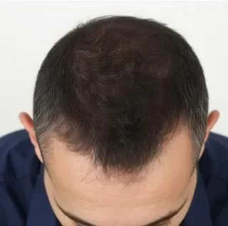 Engrosamiento capilar en cabello castaño oscuro, apariencia de cabello más grueso y relleno.