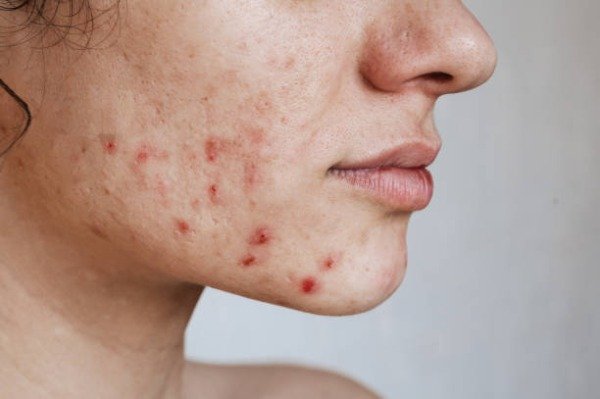 Producto - Tratamiento para ACNE