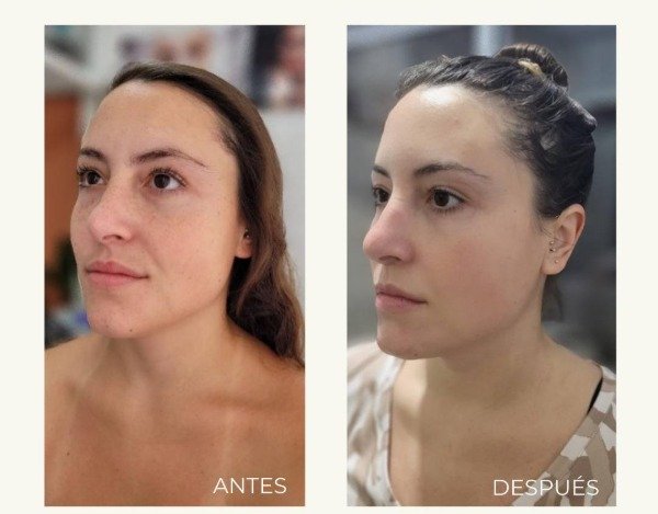 Producto - HIFU + EXOSOMAS PREMIUM (rostro+sub.menton) - 1