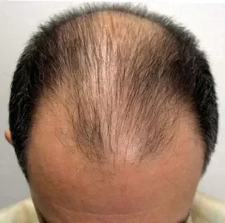 Hombre con cabello negro y entradas pronunciadas, coronilla con calvicie visible antes de usar Trick Hair Fiber.