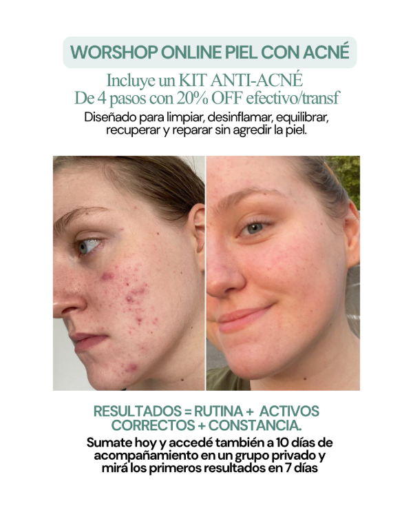 Producto - workshop skincare acné ONLINE