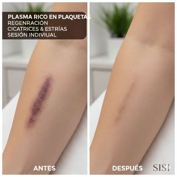 Producto - PRP Repair: Especial Cicatrices y Estrías