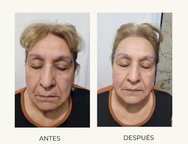 Producto - HIFU + HIGIENE BASICA (rostro+sub-menton) - 0
