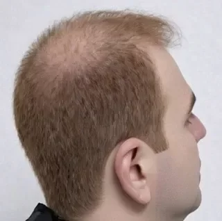 Cabello castaño claro con cabello muy fino y débil en la coronilla.