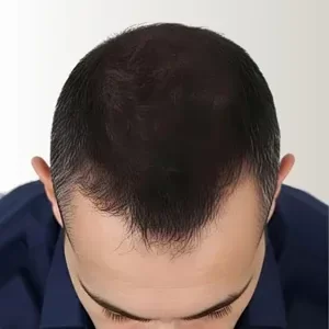 Engrosamiento capilar en cabello castaño oscuro, apariencia de cabello más grueso y relleno.