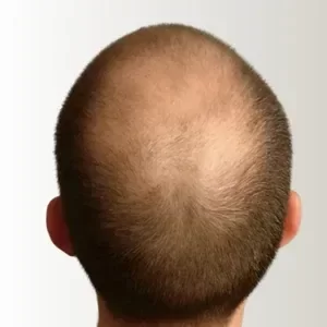 Coronilla con falta total de densidad en cabello castaño medio antes de usar Trick Hair Fiber.