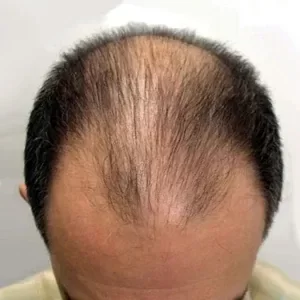 Hombre con cabello negro y entradas pronunciadas, coronilla con calvicie visible antes de usar Trick Hair Fiber.