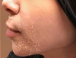 Producto - Ácidos DESCAMANTES en invierno peeling- PRESENCIAL