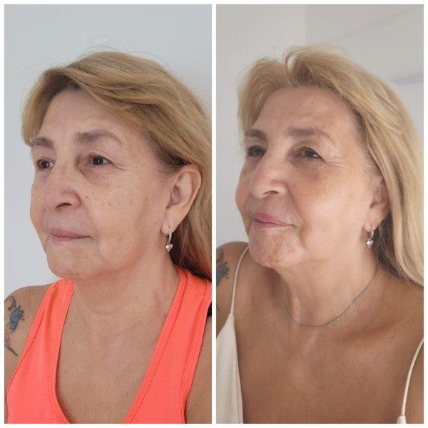 Producto - HIFU + HIGIENE BASICA (rostro+cuello+escote) - 1