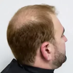 Cabello castaño claro con cabello muy fino y débil en la coronilla.