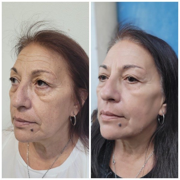 Producto - HIFU + EXOSOMAS NACIONALES (rostro +cuello + escote) - 1