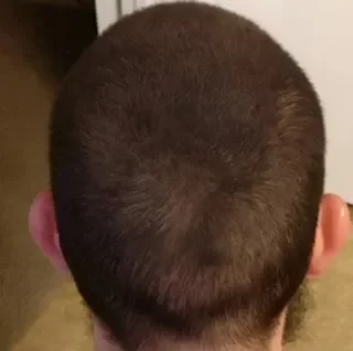 Efecto de densidad capilar en coronilla castaño medio, zonas de calvicie cubiertas con Trick Hair Fiber.