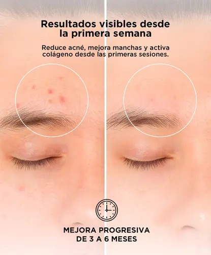 Producto - Mascara facial led -terapia fotodionmica -antiacon/rejuvenecimiento -192 luces - - 4