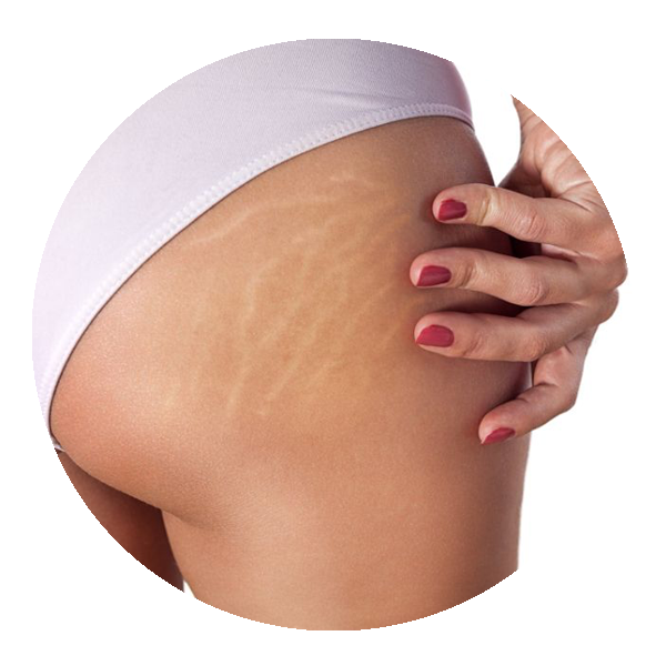 Producto - Tratamiento ESTRIAS