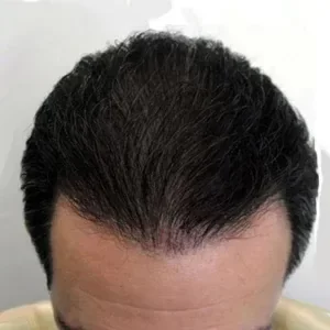 Cobertura total de entradas y coronilla en cabello negro tras aplicar fibras capilares Trick Hair Fiber, resultado con mayor volumen y densidad.