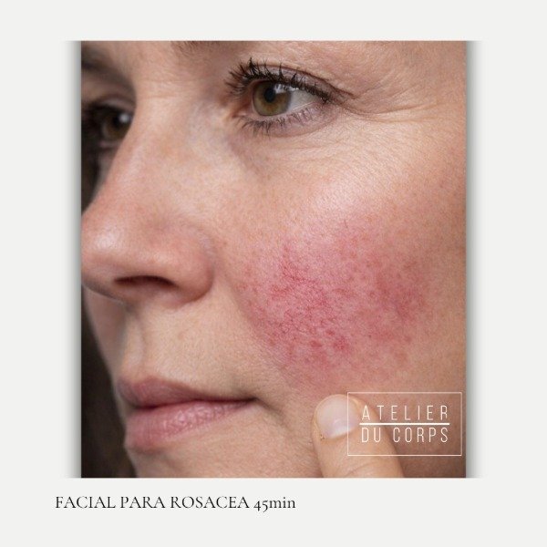 Producto - Facial para Rosácea 45 min