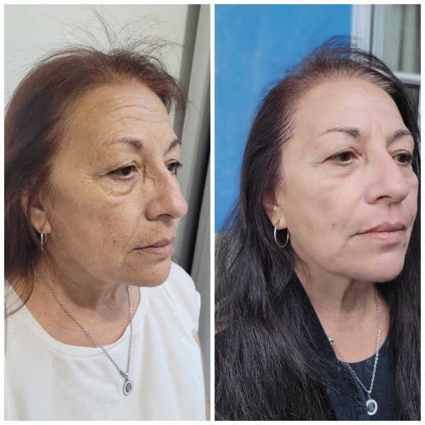 Producto - HIFU + EXOSOMAS NACIONALES (rostro +cuello + escote) - 2