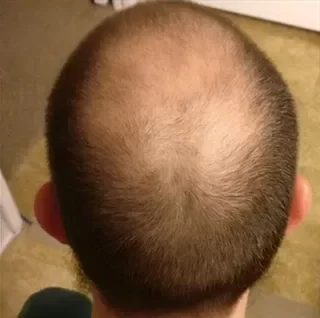 Coronilla con falta total de densidad en cabello castaño medio antes de usar Trick Hair Fiber.