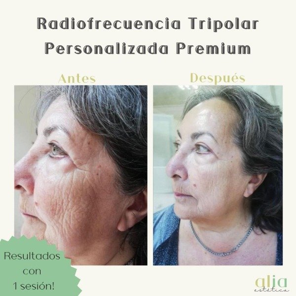 Producto - Radiofrecuencia + Exosomas  Premiums + Higiene profunda - 0