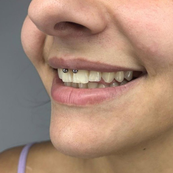 Producto - Perforación Smiley